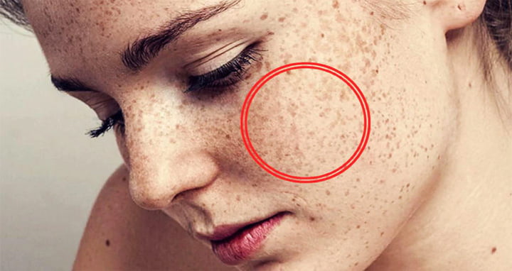 মুখের ছুলির দাগে বিব্রত? জেনে নিন ৬টি অব্যর্থ ঘরোয়া টোটকা